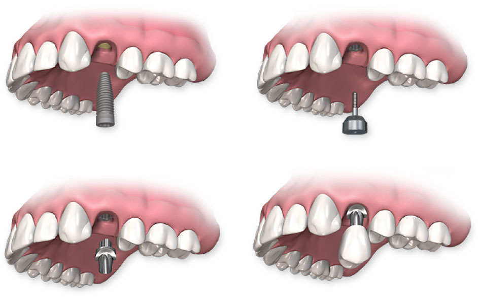 Dental Implants in Bellevue, WA - Premier Periodontics