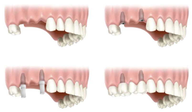 Bellevue Dental Implant - Missing teeth can mean more than just a gap in  your smileThey can lead to a lack of confidenceThey can even contribute  to further jaw problems.